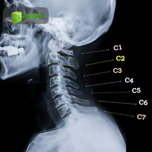 تشخیص بیماری دیسک گردن
